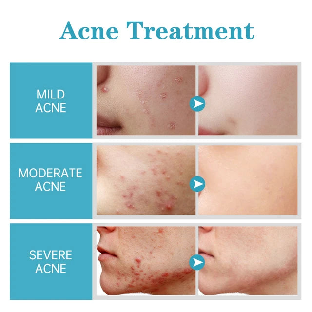 AUQUEST Salicylic Acid Acne Face Cream